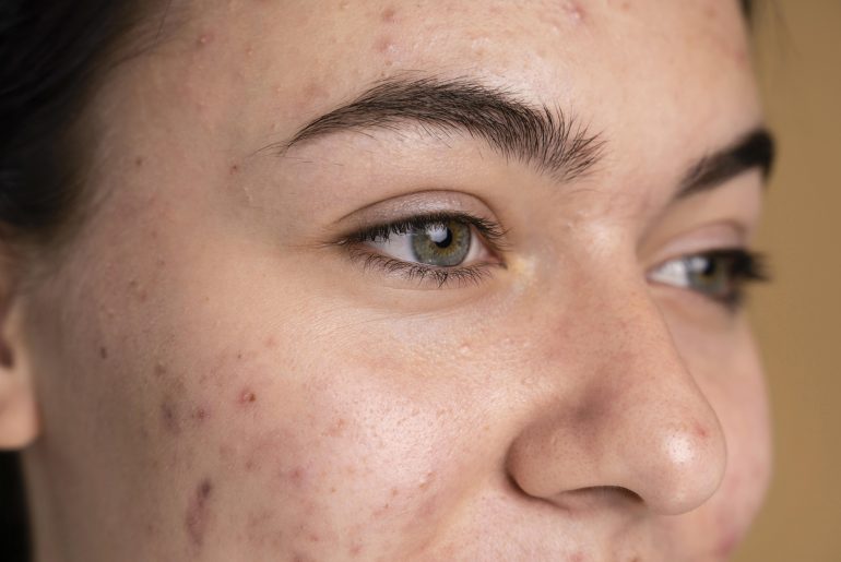 remove dark spots caused by pimples