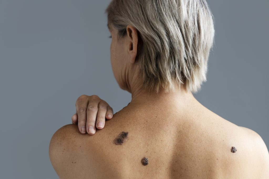 home remedies for skin tags