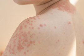 hives on skin
