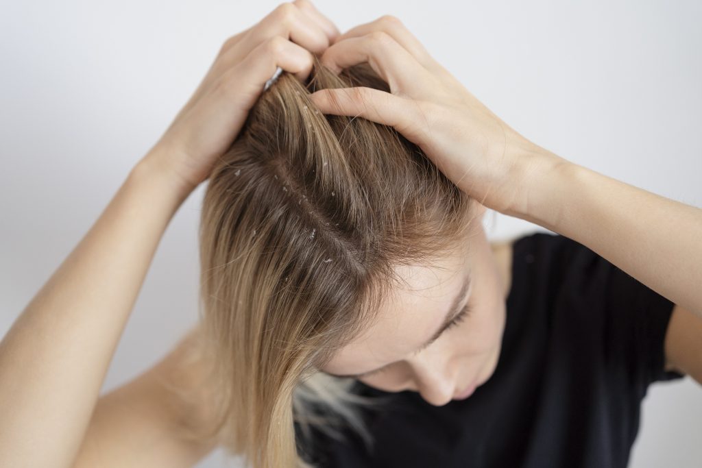 natural remedy for dandruff