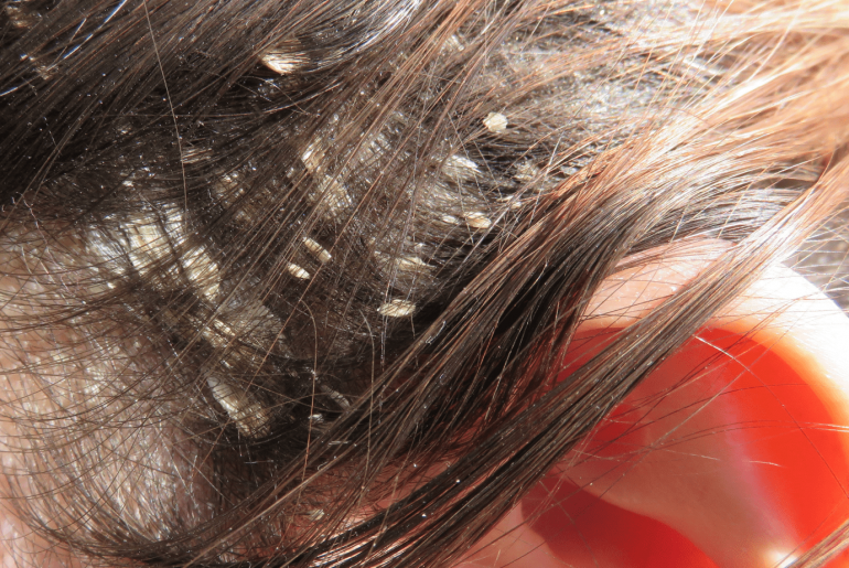 psoriasis of the scalp