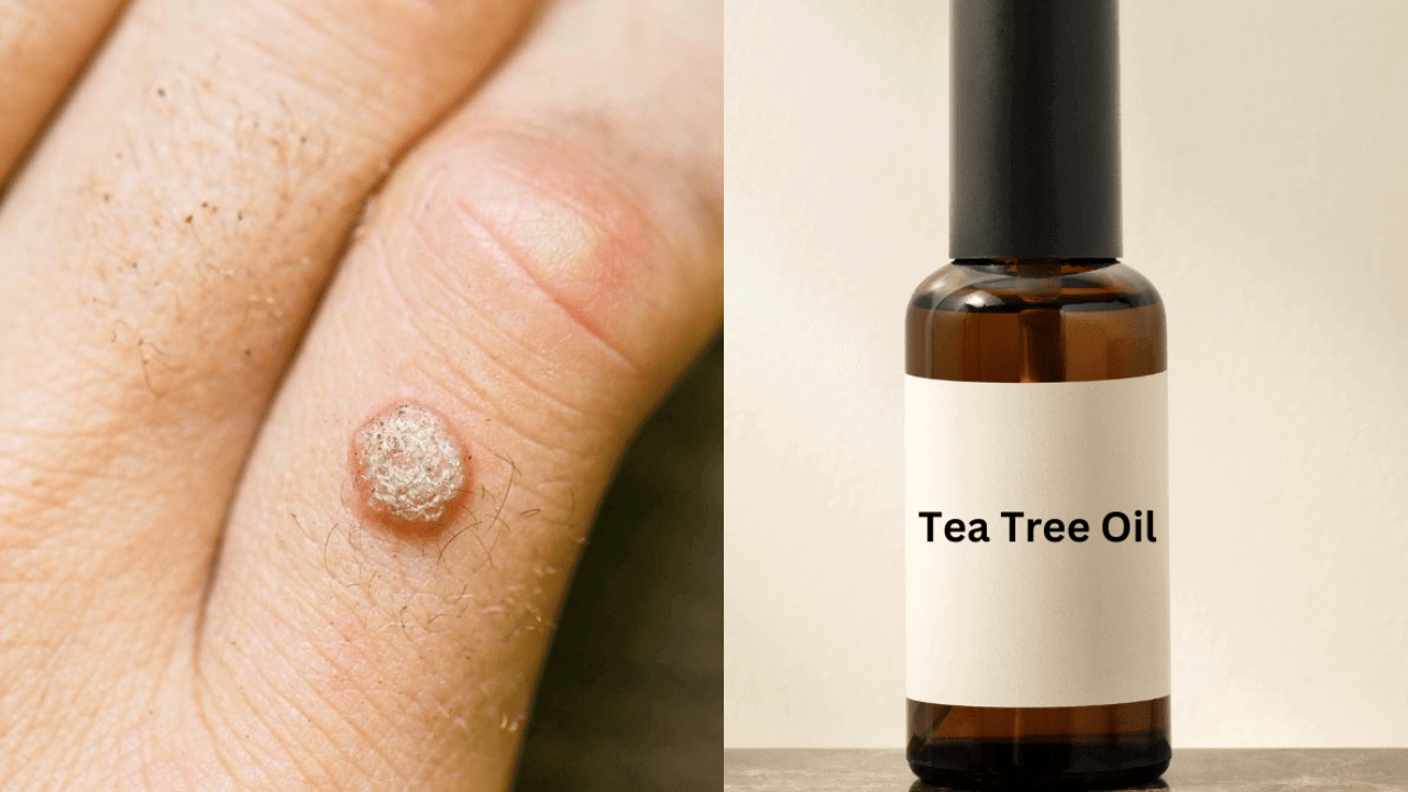 tea tree oil for warts